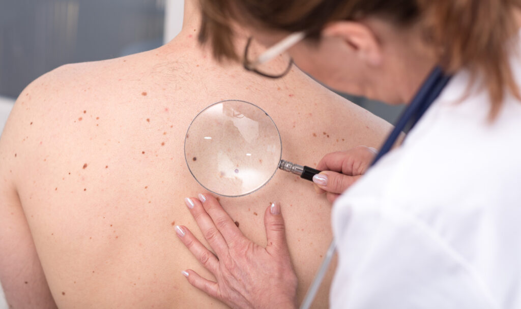 Melanomi in allarmante aumento: 2024 "annus horribilis" 1 MELANOMA 1