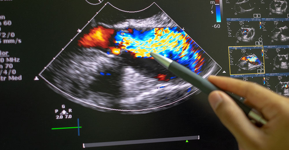 Ecografia Cardiologica: un alleato indispensabile per la salute del cuore nel 2025 1 ecocardiogramma esami medical group italia