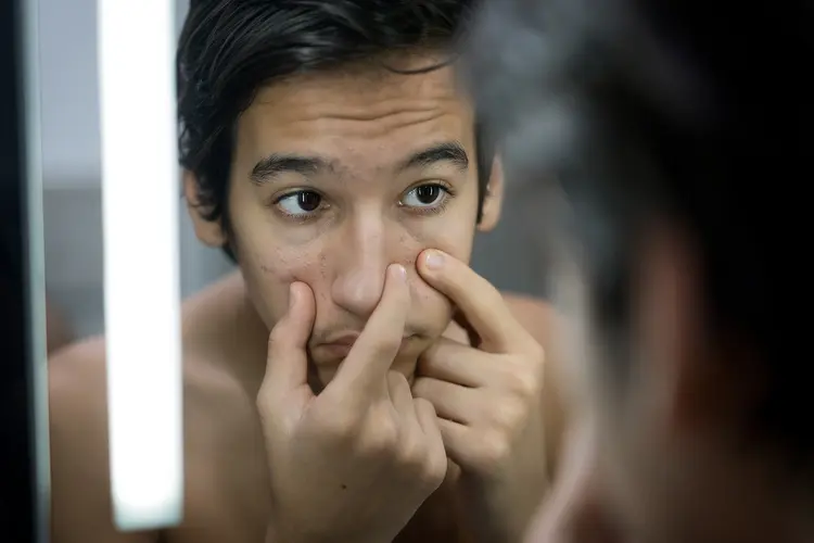 Acne adolescenziale: "il compagno di viaggio" dell'85% dei giovani uomini e delle giovani donne nel mondo 1