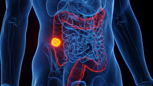 Tumore al colon in netta crescita tra gli under 50: sintomi, cause e nuove prospettive terapeutiche 1 Perché il tumore al colon colpisce sempre più giovani?