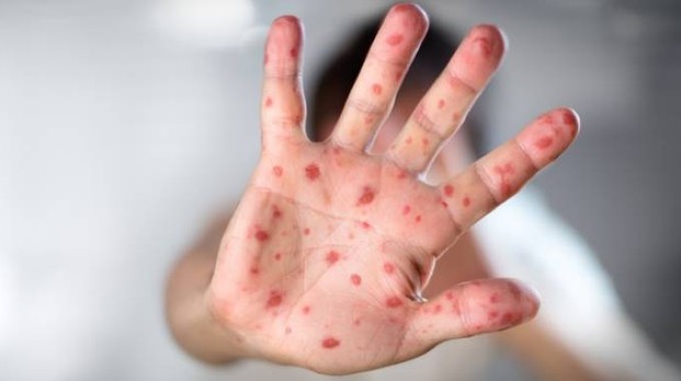 Morbillo. Pediatri: "Solo il vaccino protegge davvero. I dati smentiscono le false credenze" 1 morbillo mano