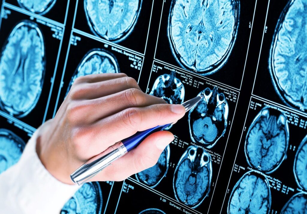 Sistema immunitario e memoria: una nuova scoperta contro l'Alzheimer 1 La vulnerabilità precoce e il ruolo del sistema immunitario