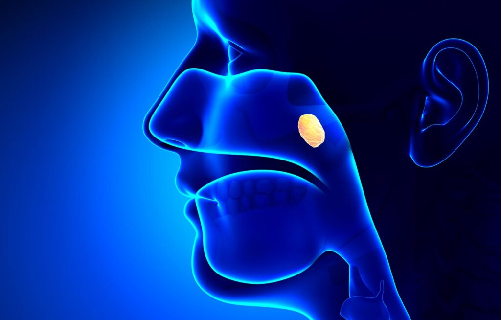Aprile, il mese della prevenzione per i tumori testa-collo 1 Verso trattamenti più leggeri e personalizzati nei tumori testa-collo
