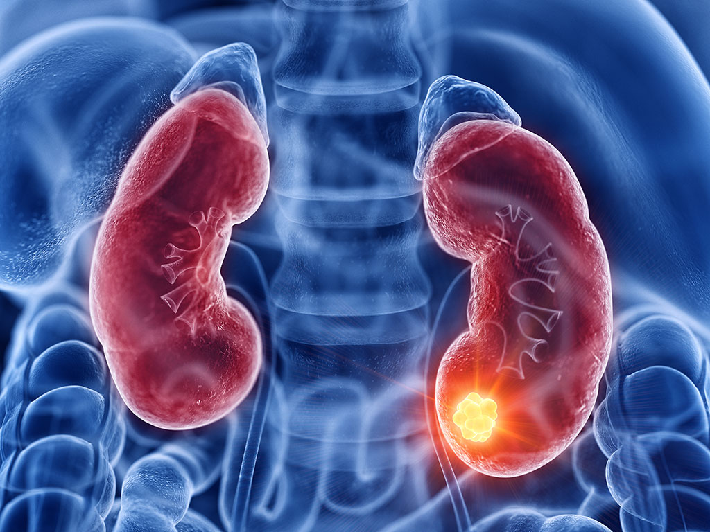 Tumore al rene: diagnosi tardive e importanza della prevenzione 1 La campagna "Fianco a Fianco": sensibilizzare per una diagnosi più rapida per il tumore al rene