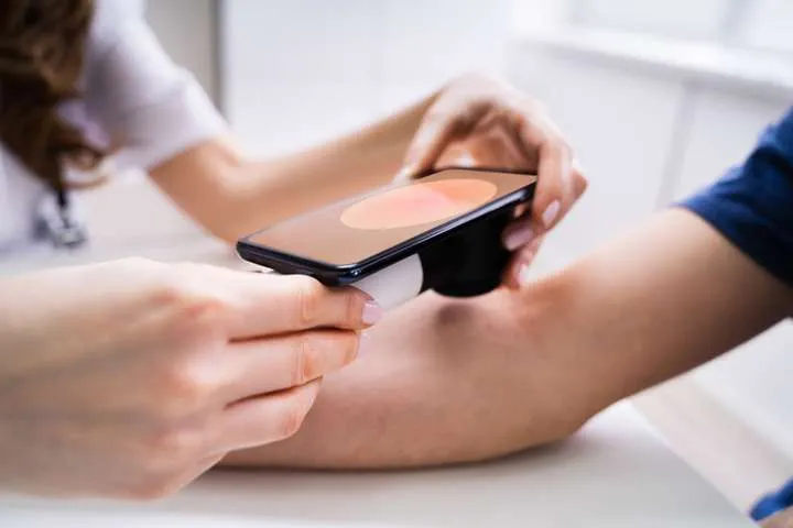 Come funziona Telemo nella battaglia contro il melanoma