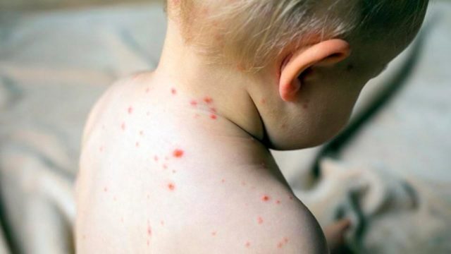 Morbillo in Italia: 269 casi nei primi quattro mesi del 2025 1 Modalità di trasmissione e focolai di morbillo