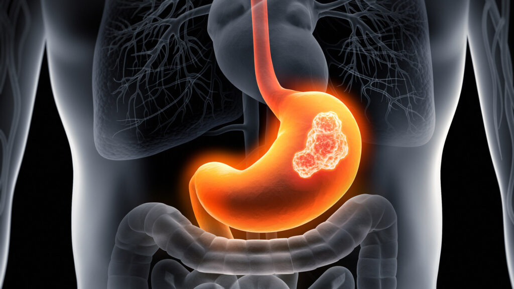 Nuove speranze nella terapia del tumore gastrico metastatico: migliora la sopravvivenza grazie a un farmaco mirato 1 Tumore gastrico: nuove speranze in una battaglia difficile