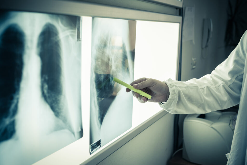 Tumore del polmone, immunoterapia: via libera UE per tislelizumab 1 La speranza per le cure del tumore al polmone arriva dalla Commissione Europea
