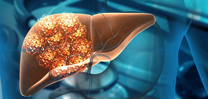 Tumore del pancreas, una nuova strategia chemioterapica migliora la sopravvivenza dei pazienti 1 Visite specialistiche mirate e diagnosi precoce del tumore al pancreas, tra i numeri uno per mortalità