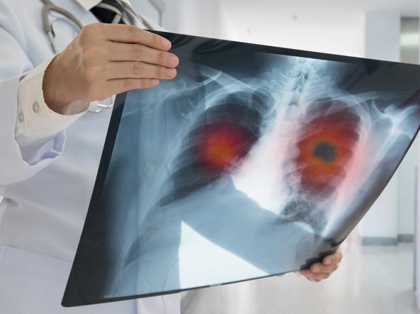Tumore al polmone, nuova prospettiva da composto marino in associazione a immunoterapia 1 Salute respiratoria e stili di vita: la battaglia contro il tumore al polmone a tutti i livelli