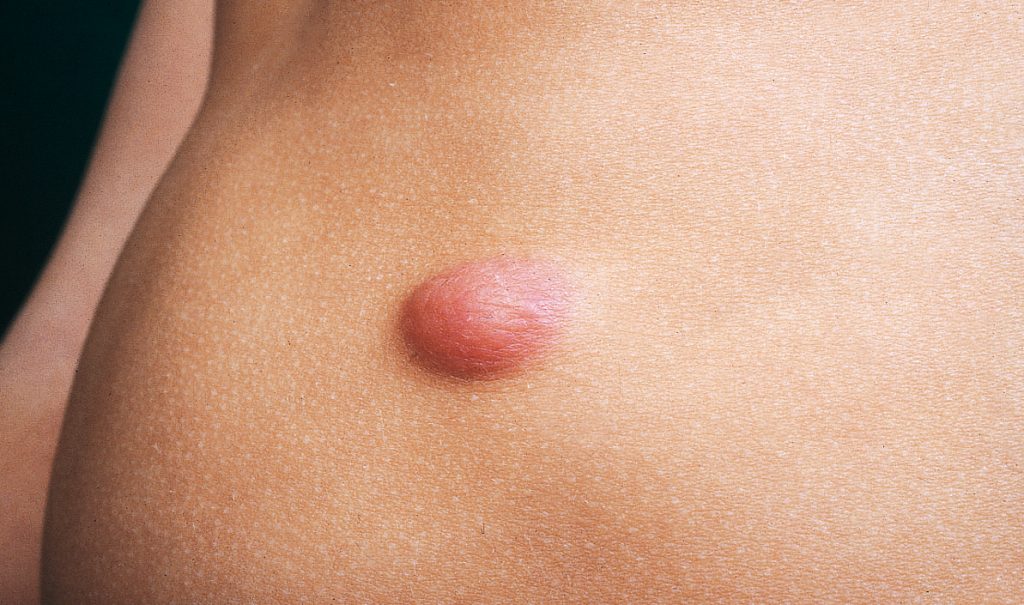Cisti benigne o maligne? Come riconoscerle e distinguerlex 1 Cosa sono le cisti