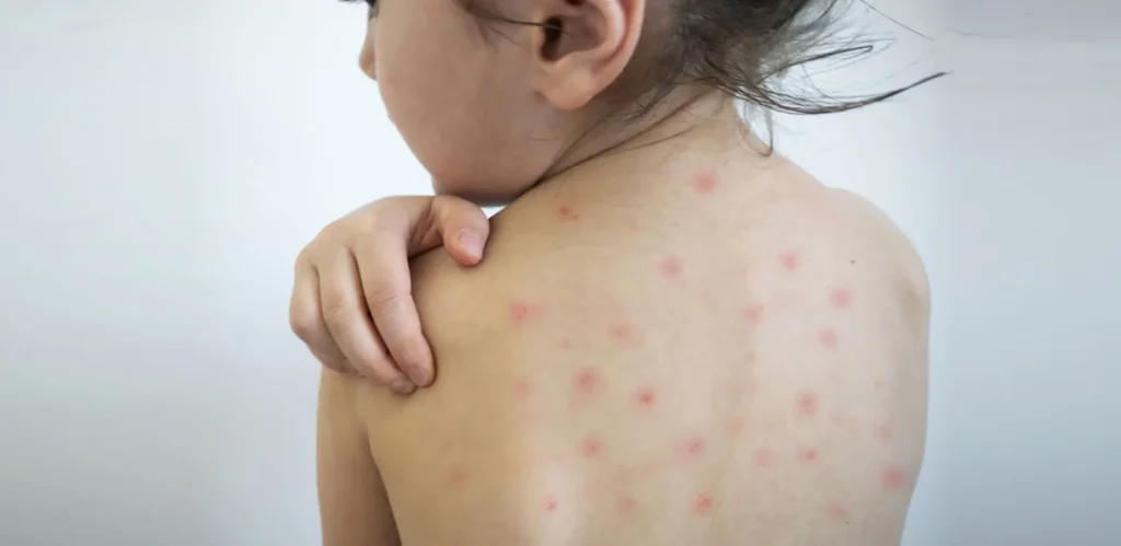 Morbillo oggi: il contesto italiano