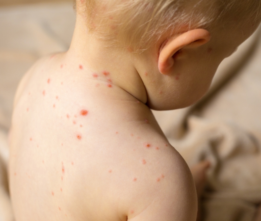 varicella orig