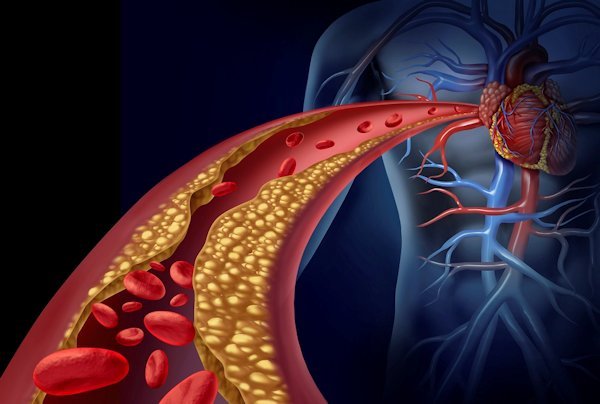 Aterosclerosi, nuove evidenze Esc sulle terapie che aiutano a individuare precocemente i pazienti a rischio 1 aterosclerosi