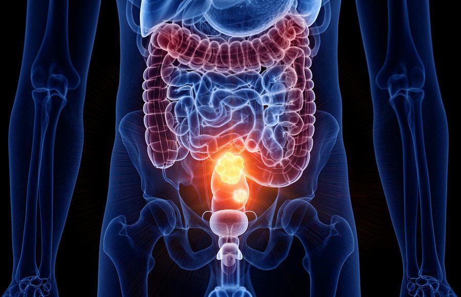 Dalla lesione benigna al tumore del colon-retto: un processo lungo ma prevenibile