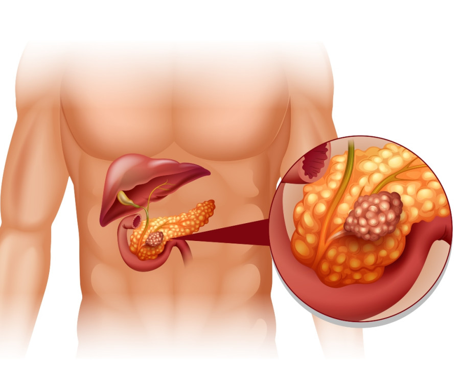 Tumore del pancreas, la FDA approva il primo dispositivo non invasivo per trattamento locale 1 Tumore del pancreas: una malattia difficile da intercettare precocemente