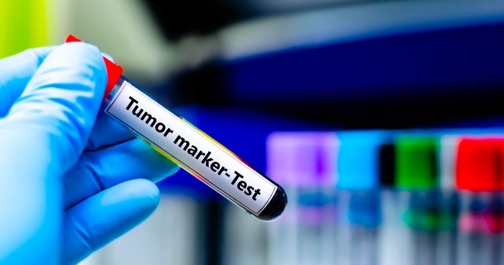 Tumori, in Europa crollano i trial clinici: in dieci anni dimezzate le sperimentazioni. Senza prevenzione non c'è futuro per le cure 1 shutterstock 2689328055 modificata