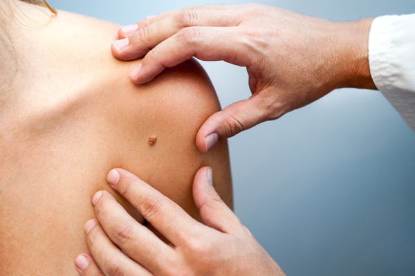 Visite dermatologiche e prevenzione mirata per il "nemico" melanoma