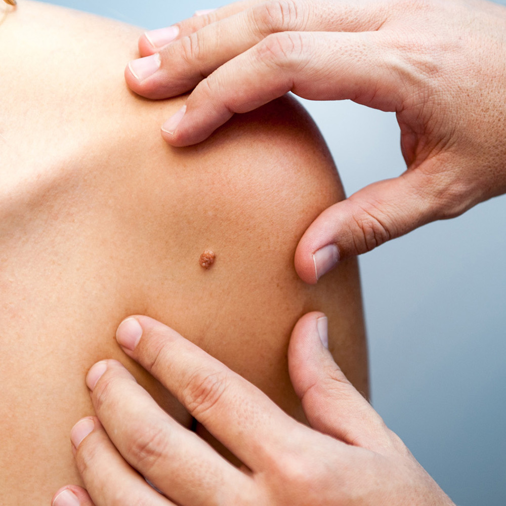 Melanoma: vaccini personalizzati e nuove immunoterapie cambiano il futuro delle cure 1 L'immunoterapia viene utilizzata sempre più precocemente nella cura del melanoma