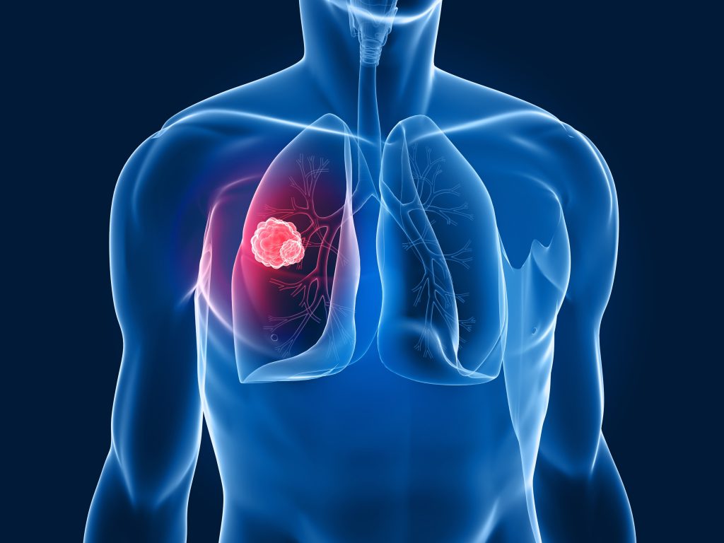 Tumore del polmone avanzato, il trapianto potrebbe offrire una nuova possibilità nei casi altamente selezionati 1 Visite specialistiche mirate, sintomi e diagnosi