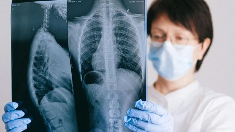 Visite specialistiche e prevenzione mirata: ecco i sintomi da non sottovalutare per scongiurare il tumore del polmone