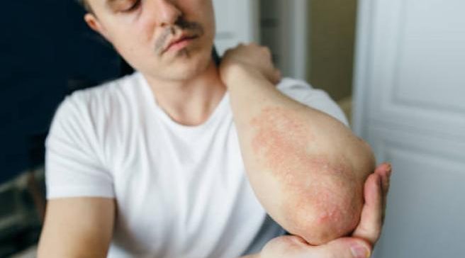 Psoriasi: malattia vera o solo stress? La verità tra scienza e prevenzione 6 {{brizy_dc_image_alt entityId=