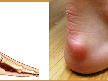 Haglunds-Deformity-1-2 ?brizy media=33915&brizy crop=iW%3D659%26iH%3D248%26oX%3D163%26oY%3D0%26cW%3D331%26cH%3D248