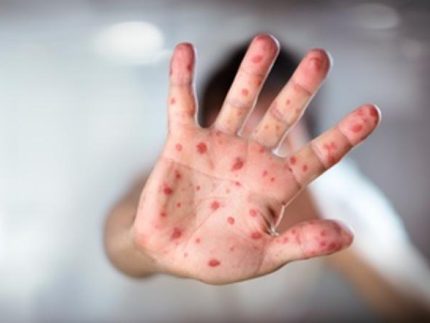 Morbillo-1 ?brizy media=33020&brizy crop=iW%3D333%26iH%3D248%26oX%3D0%26oY%3D0%26cW%3D331%26cH%3D248