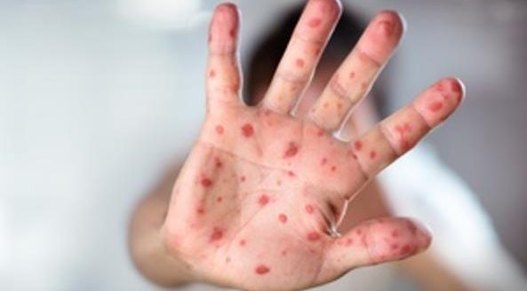 Morbillo 1