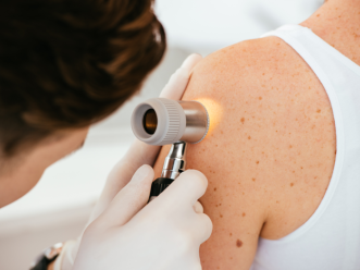 Prevenzione-Melanoma Prevenzione Melanoma