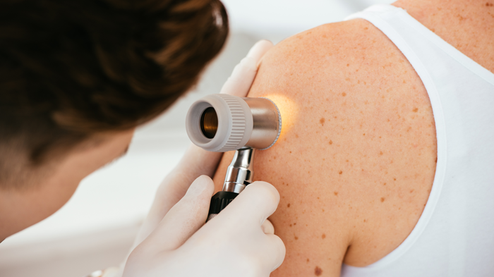 Prevenzione Melanoma