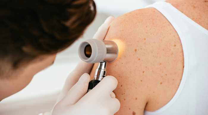 Prevenzione-Melanoma Prevenzione Melanoma