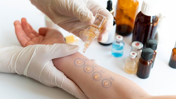Quali sono e come si fanno le prove allergiche