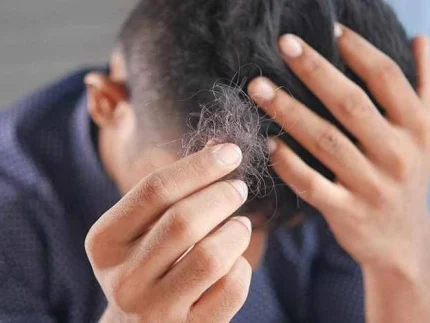 alopecia ?brizy media=32138&brizy crop=iW%3D396%26iH%3D248%26oX%3D32%26oY%3D0%26cW%3D331%26cH%3D248