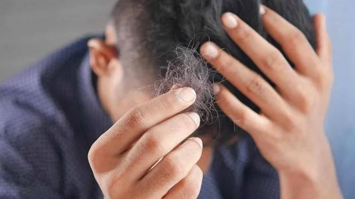 alopecia