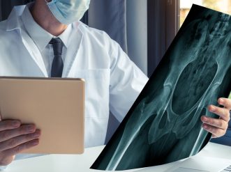Doctor watching a x-ray of bones of hips and holding a digital tablet anca medico