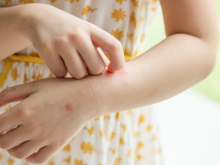 Little girl has skin rash allergy itching and scratching on her arm ?brizy media=33644&brizy crop=iW%3D432%26iH%3D248%26oX%3D50%26oY%3D0%26cW%3D331%26cH%3D248