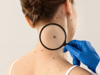 che-cosa-e-il-melanoma che cosa e il melanoma