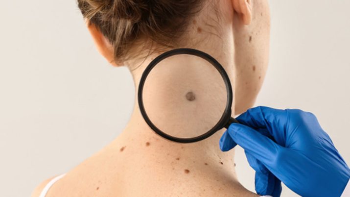 che cosa e il melanoma