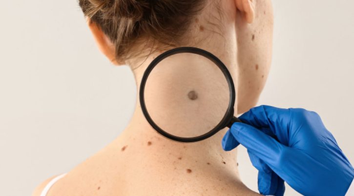 che-cosa-e-il-melanoma che cosa e il melanoma