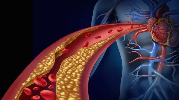 colesterolo LDL