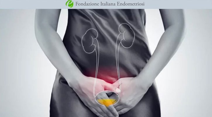 endometriosi-vescicale endometriosi vescicale