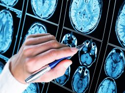 epilessia e1657038008220