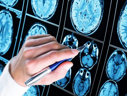Doctor,Pointing,With,Pen,To,The,Brain ?brizy media=34343&brizy crop=iW%3D371%26iH%3D248%26oX%3D19%26oY%3D0%26cW%3D331%26cH%3D248