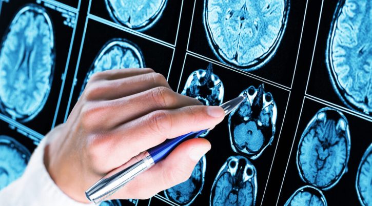 Doctor,Pointing,With,Pen,To,The,Brain epilessia e1657038008220