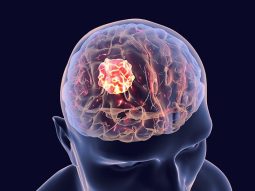 glioblastoma foto
