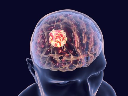 glioblastoma-foto ?brizy media=33921&brizy crop=iW%3D372%26iH%3D248%26oX%3D20%26oY%3D0%26cW%3D331%26cH%3D248