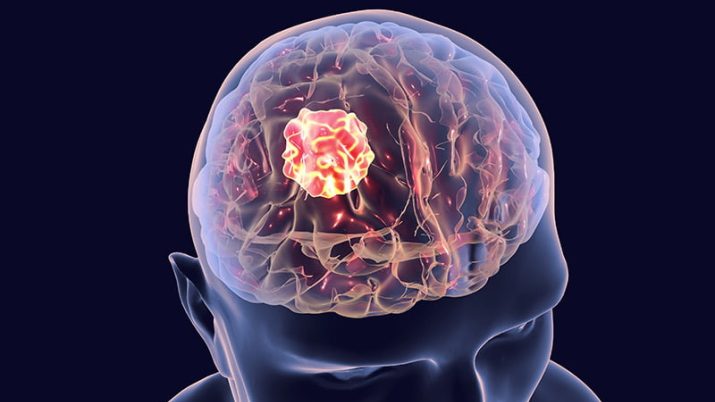glioblastoma foto