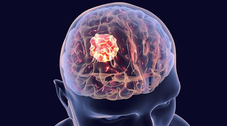 glioblastoma foto