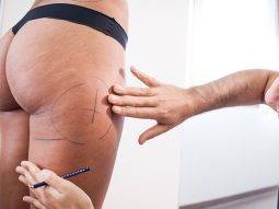 liposuzionemininv-1 liposuzionemininv 1